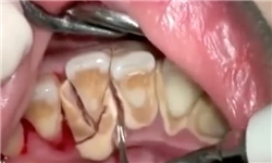 استفاده از سلول‌های بنیادی در درمان بیماری‌های دهان، فک و صورت