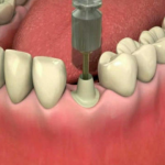 ایمپلنت یا کاشت دندان
