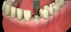 اطلاعاتی بیشتر درباره ایمپلنت یا کاشت دندان