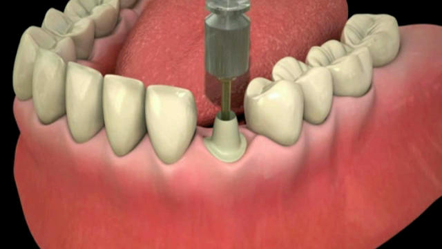 ایمپلنت یا کاشت دندان