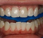 Nine Shades of Full-Mouth Whitening in 20 Minutes