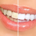بررسی دردهای ناشی از سفید کردن دندان