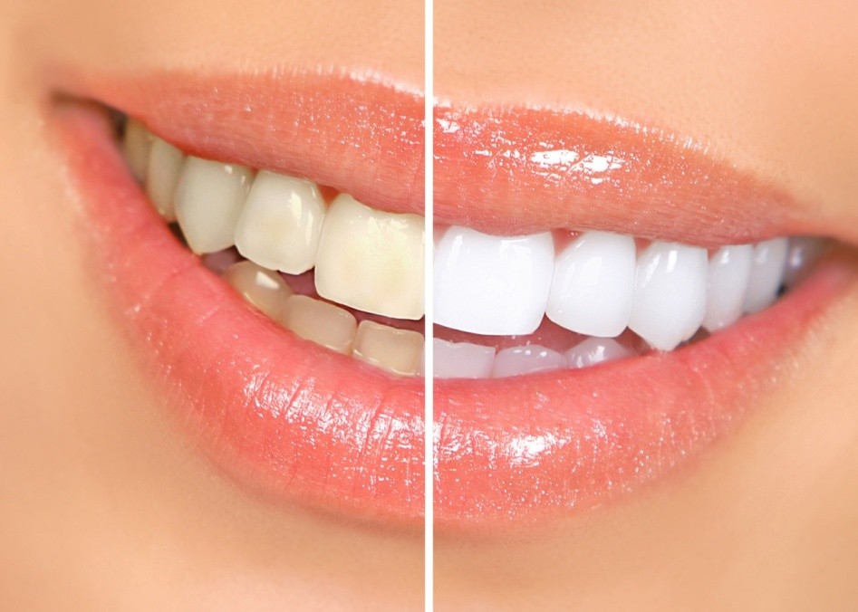 بررسی دردهای ناشی از سفید کردن دندان