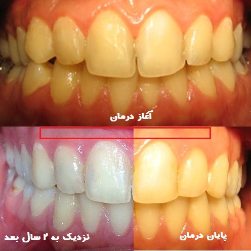 آیا رنگ دندان ها بعد از ارتودنسی زرد می شود؟