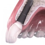موفقیت درمان ایمپلنت دندان در آینده ای نزدیک با پروتئین استخوان ساز تضمین می شود!
