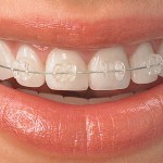 آیا رنگ دندان ها بعد از ارتودنسی زرد می شود؟