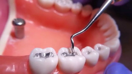 آمالگام تهدید جدی برای سلامتی بیماران و دندانپزشکان