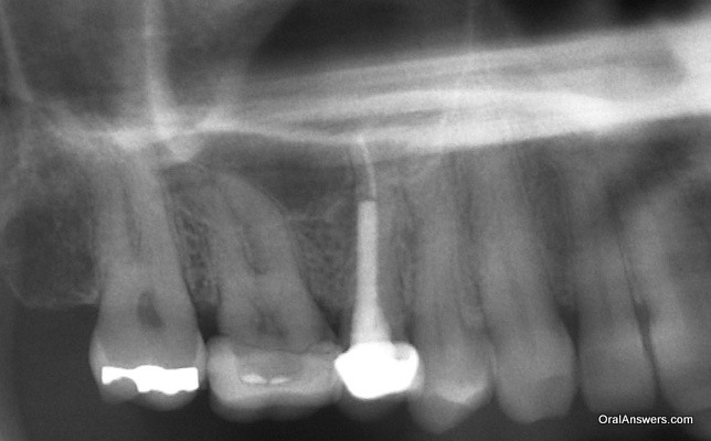 یک نمونه از سینوزیت ناشی از دندان