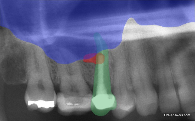 بخش سبز رنگ در تصویر دندان، بخش قرمز رنگ عفونت و بخش آبی رنگ سینوس است.