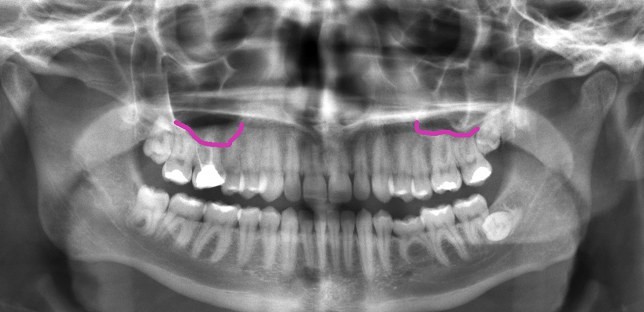 سینوس چگونه باعث دندان درد میشود؟