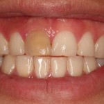 تغییر رنگ دندان بعد از عصب کشی
