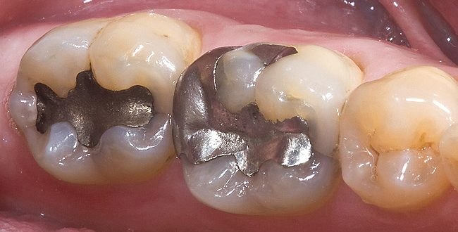 آمالگام های دندانی سمی هستند؟